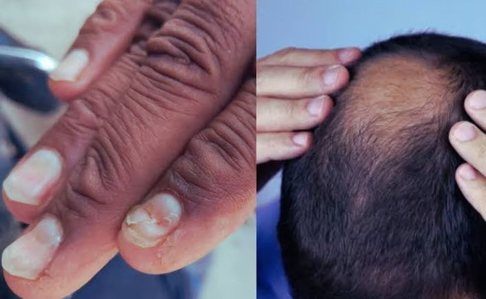 Hair fall and nail health
